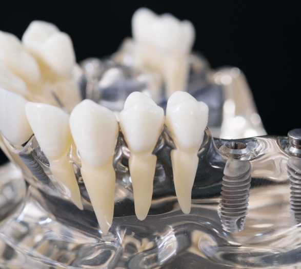 implant-orthodontic-model-student-learning-teaching-model-showing-teeth